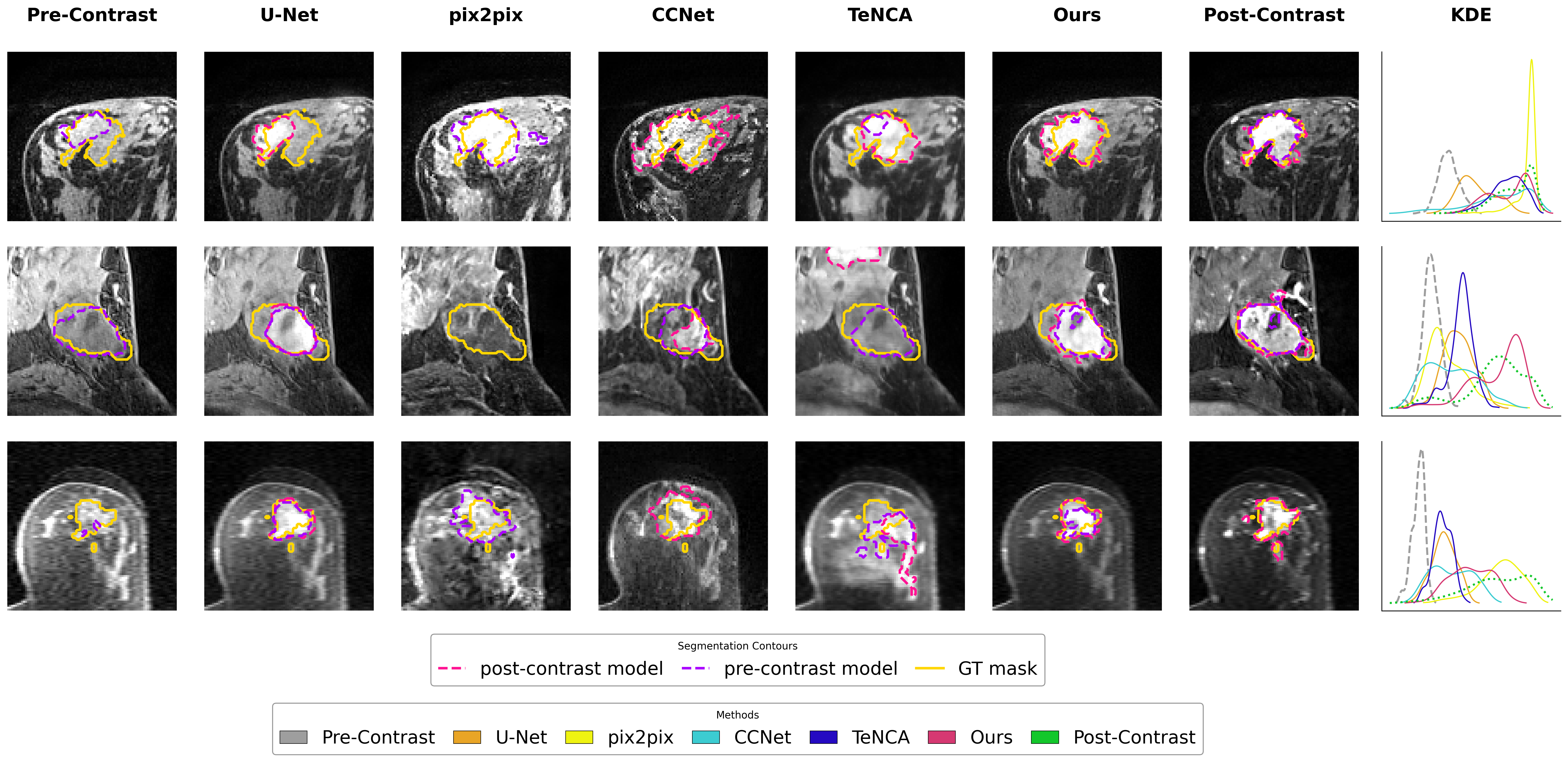 Qualitative downstream segmentation results per patient case across real and synthesized images, with kernel density estimation of intensities inside the ground truth mask.